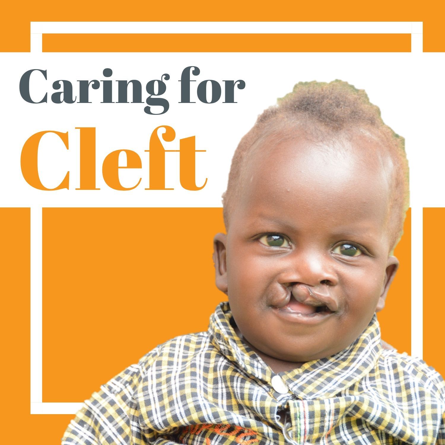 How a 3D Cleft Palate Simulator is Transforming Cleft Surgery How a 3D Cleft Palate Simulator is Transforming Cleft Surgery